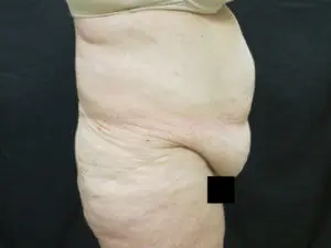 Pickart Plastic Surgery Before and After Pictures