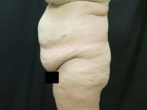 Pickart Plastic Surgery Before and After Pictures