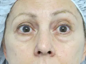 Pickart Plastic Surgery Before and After Pictures