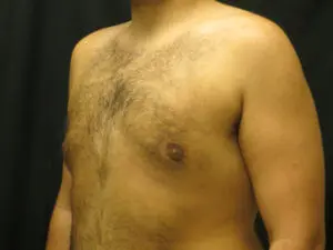 Pickart Plastic Surgery Before and After Pictures