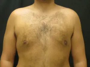 Pickart Plastic Surgery Before and After Pictures