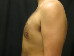 Pickart Plastic Surgery Before and After Pictures