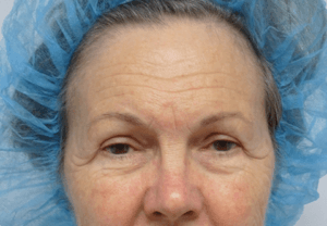 Pickart Plastic Surgery Before and After Pictures