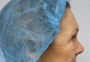 Pickart Plastic Surgery Before and After Pictures