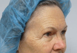 Pickart Plastic Surgery Before and After Pictures