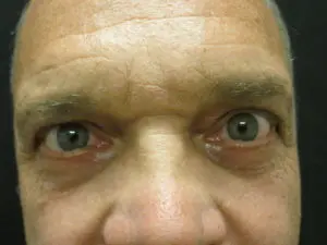 Pickart Plastic Surgery Before and After Pictures