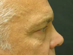 Pickart Plastic Surgery Before and After Pictures