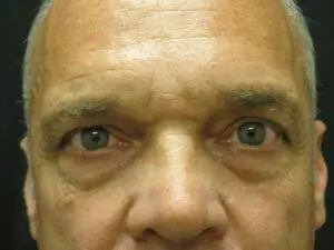 Pickart Plastic Surgery Before and After Pictures