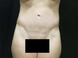 Pickart Plastic Surgery Before and After Pictures