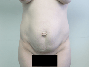 Pickart Plastic Surgery Before and After Pictures