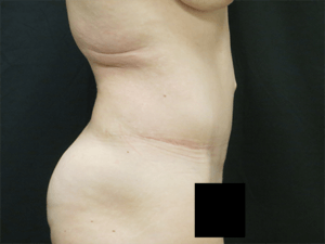 Pickart Plastic Surgery Before and After Pictures