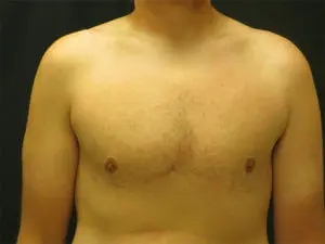 Pickart Plastic Surgery Before and After Pictures