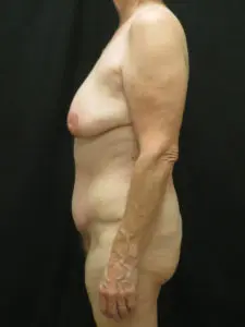 Pickart Plastic Surgery Before and After Pictures