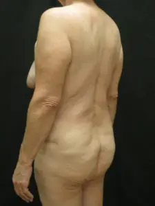 Pickart Plastic Surgery Before and After Pictures