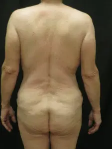 Pickart Plastic Surgery Before and After Pictures