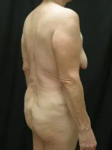 Pickart Plastic Surgery Before and After Pictures