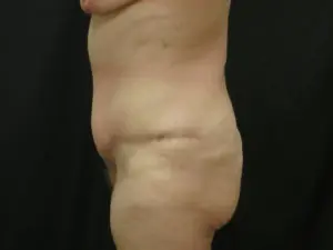 Pickart Plastic Surgery Before and After Pictures