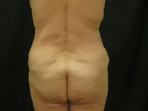 Pickart Plastic Surgery Before and After Pictures