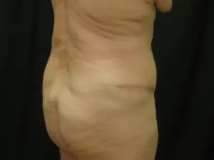 Pickart Plastic Surgery Before and After Pictures