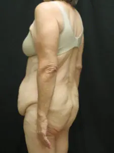 Pickart Plastic Surgery Before and After Pictures