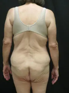 Pickart Plastic Surgery Before and After Pictures