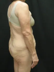 Pickart Plastic Surgery Before and After Pictures