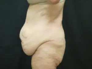 Pickart Plastic Surgery Before and After Pictures