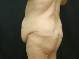 Pickart Plastic Surgery Before and After Pictures