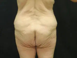 Pickart Plastic Surgery Before and After Pictures