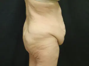 Pickart Plastic Surgery Before and After Pictures