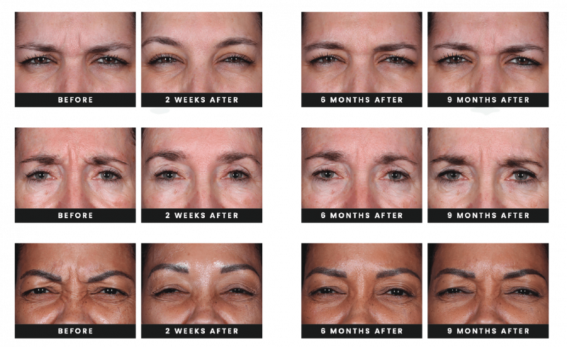 Daxxify® in Ventura, CA