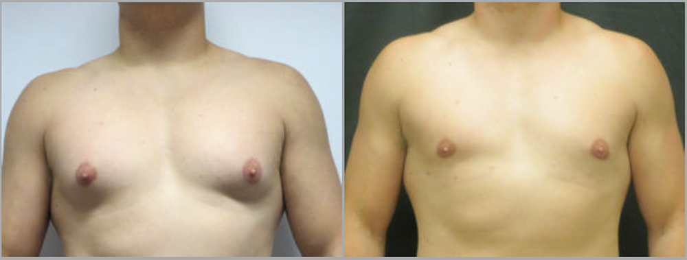 Gynecomastia in Ventura, CA