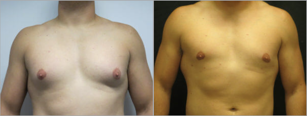 Gynecomastia in Ventura, CA