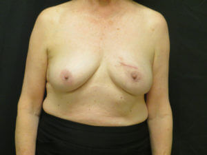 Breast Reconstruction Before and After Pictures Ventura, CA