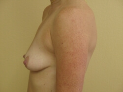 Breast Augmentation Before and After Pictures Ventura, CA