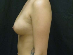 Breast Augmentation Before and After Pictures Ventura, CA