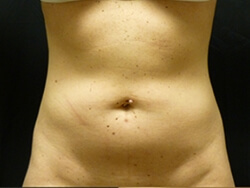 Liposuction Before and After Pictures Ventura, CA