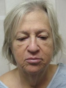 Facelift Before and After Pictures Ventura, CA