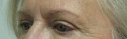 Eyelid Surgery Before and After Pictures Ventura, CA