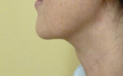 Neck Lift Before and After Pictures Ventura, CA