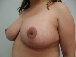 Breast Reduction Before and After Pictures Ventura, CA