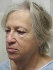 Facelift Before and After Pictures Ventura, CA