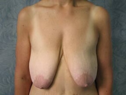 Breast Lift Before and After Pictures Ventura, CA