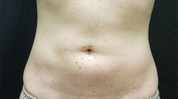 Tummy Tuck Before and After Pictures Ventura, CA