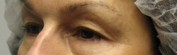 Eyelid Surgery Before and After Pictures Ventura, CA