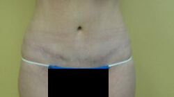 Tummy Tuck Before and After Images Ventura, CA