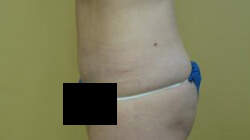 Tummy Tuck Before and After Images Ventura, CA