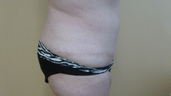 Tummy Tuck Before and After Pictures Ventura, CA