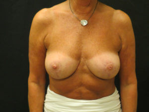 BREAST LIFT BEFORE AND AFTER PICTURES IN VENTURA, CA