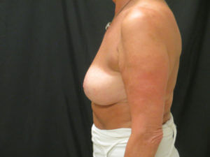 BREAST LIFT BEFORE AND AFTER PICTURES IN VENTURA, CA